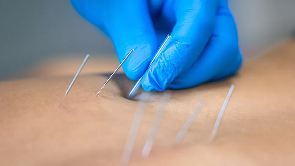 dry-Needling-1725614059-967x544-1_jpg